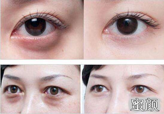 科技揭秘，最新去眼袋最佳方法，重塑眼部美麗新篇章！