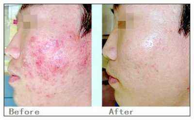 激光祛疤價格詳解，深度解析與觀點(diǎn)闡述