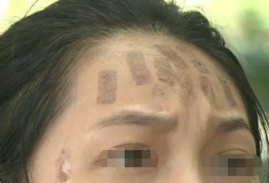 成都光子嫩膚價(jià)格，科技重塑肌膚之美