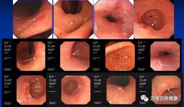 最新胃腸鏡技術(shù)，醫(yī)學(xué)領(lǐng)域的革新之星