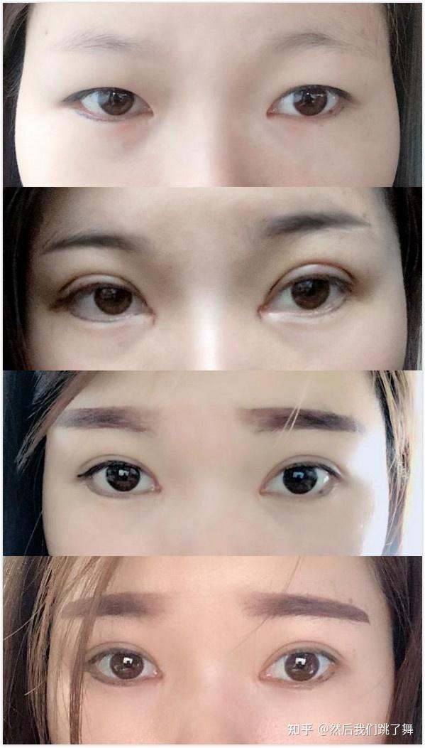 雙眼皮新技術(shù)揭秘，小明的魔法雙眼皮之旅