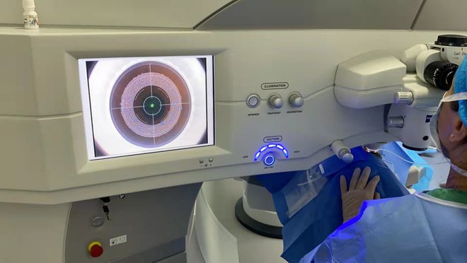 激光治療近視最新價(jià)格概覽